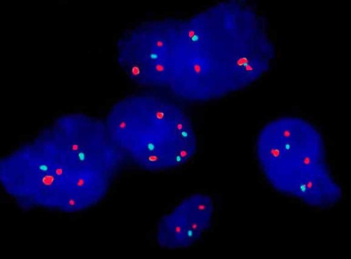 In den Kernen der Tumoren (blaugefärbt) von Patienten mit langem Überleben (mehr als 36 Monate) treten auffallend häufig zwei bestimmte Veränderungen an den Untereinheiten der Erbinformation, den Chromosomen 19 und 20 (rot markiert) auf