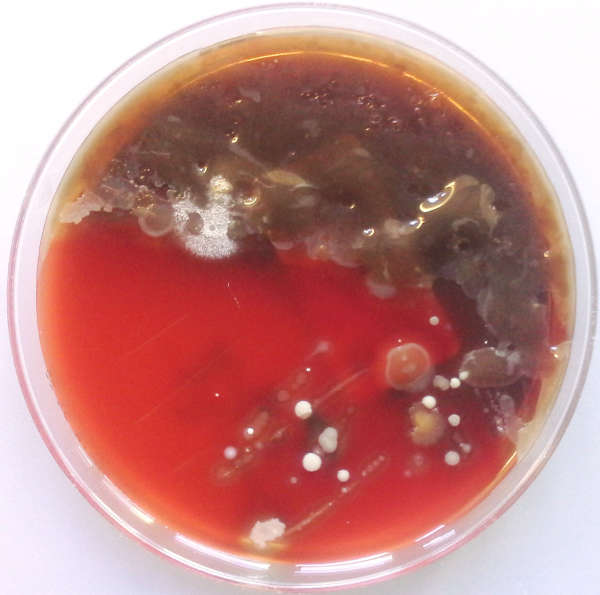 Chronische Infektionen mit dem Lungenkeim Pseudomonas – in diesem Ausstrich die braunen, schleimigen Bereiche – verändern bei Patienten mit Cystischer Fibrose das Mikrobiom in der Lunge. (Foto: Alexander Dalpke) Chronische Infektionen mit dem Lungenkeim Pseudomonas – in diesem Ausstrich die braunen, schleimigen Bereiche – verändern bei Patienten mit Cystischer Fibrose das Mikrobiom in der Lunge. (Foto: Alexander Dalpke)