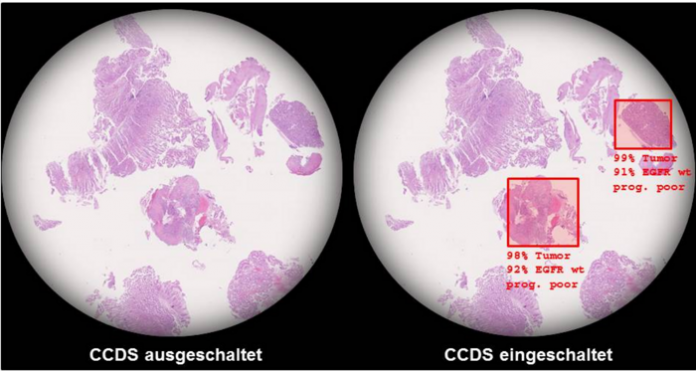 Mögliche Anwendung während der Routinediagnostik: Links – Gewebeproben einer Magenspiegelung ohne visuelle Unterstützung. Rechts – Mögliche Darstellung auffälliger Areale nach automatisierter Analyse. Neben der sogenannten Gewebedignität sollen noch weitere Informationen über molekulare oder klinische Eigenschaften angezeigt werden. (Theoretisches Modell - Entwicklung noch nicht abgeschlossen - Keine klinische Anwendung) Quelle: Dr. S. Försch